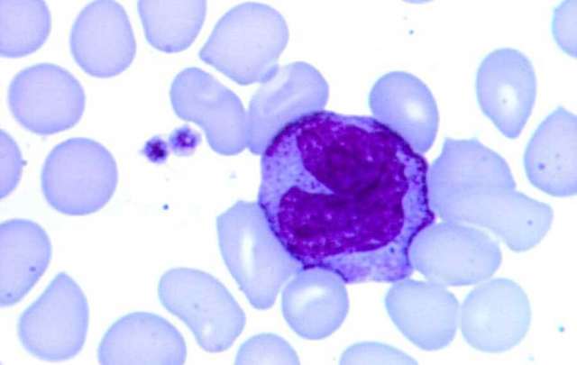 Повышены моноциты у взрослого: причины