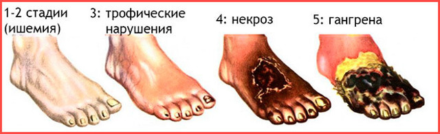 Рожа на ноге фото начальная стадия: Как начинается? - BadAcne