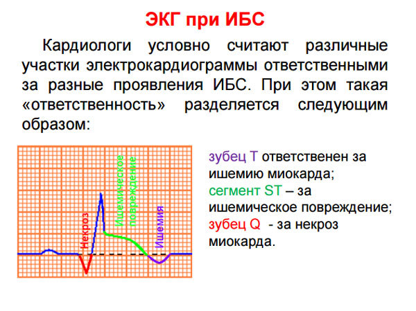 Признаки ишемии — E-Cardio