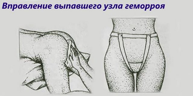 Что делать если геморрой не вправляется — Сайт о геморрое