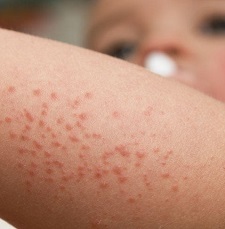 Тромбоцитопения: причины и лечение у взрослых