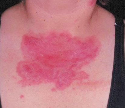 Волчанка - причины, признаки и симптомы, лечение