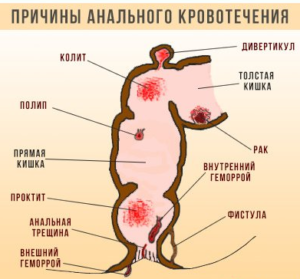 Причины кровотечения из заднего прохода. Что делать, последствия