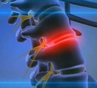 Инсульт спинного мозга (спинальный): симптомы, лечение, последствия