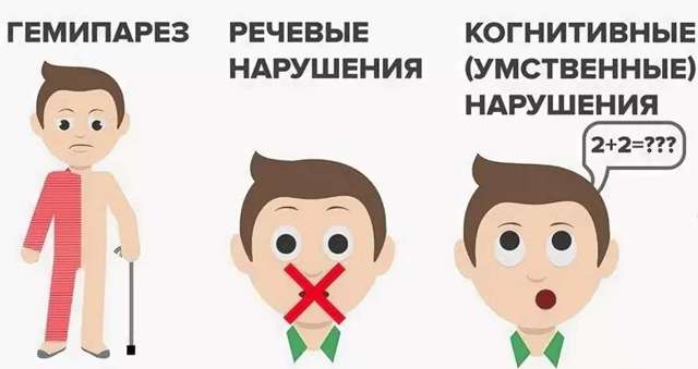 Микроинсульт – симптомы и последствия, признаки, лечение, или Берегите здоровье смолоду