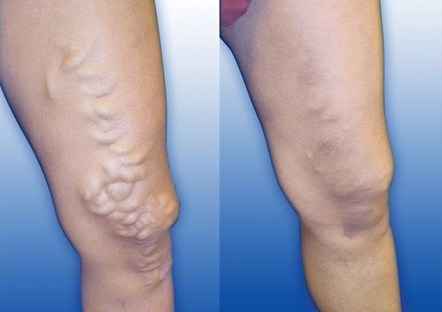 Васкулит как долго лечится. Васкулит – опасное заболевание кровеносных сосудов