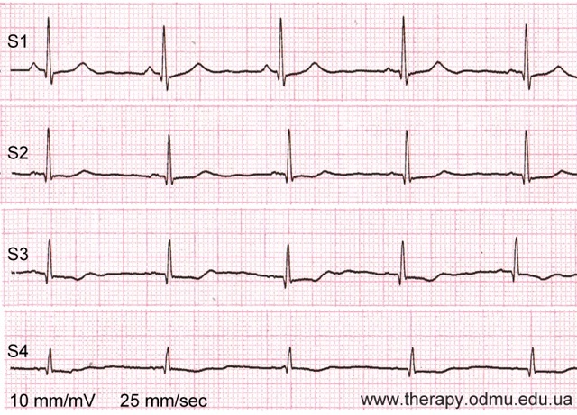 Стандартные отведения от конечностей - 1,2,3