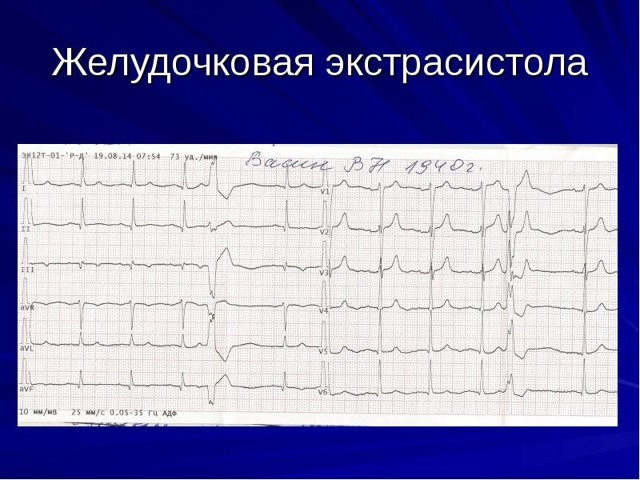 ЭКГ — что это такое, как его делают и что означают его показатели?