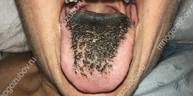 Черный налет на языке — начало больших проблем