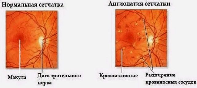 Ангиопатия сетчатки глаза - симптомы, причины и лечение