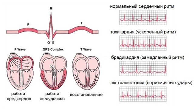 Чем опасна аритмия сердца