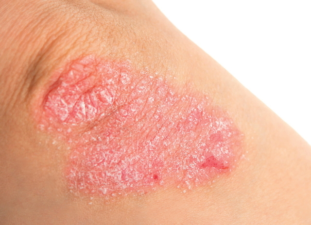 Лечение псориаз на руках - фото, симптомы, виды псориаза на руках