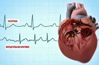 Лечение аритмии сердца народными средствами и симптомы проявления