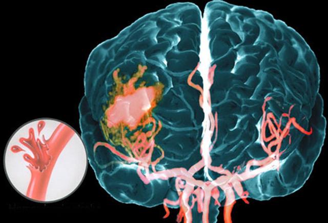 Пульс при геморрагическом инсульте - Инсульт