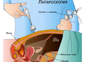 Хламидиоз при беременности: лечение и последствия для ребенка