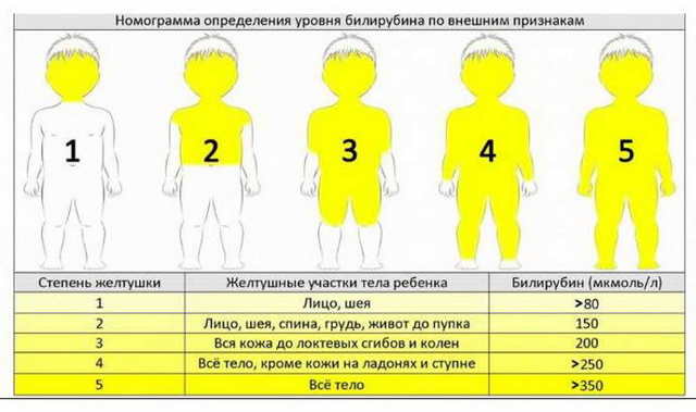Билирубин у новорожденных