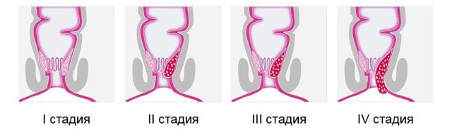 Первая стадия геморроя: лечение, причины, симптомы