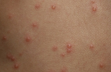 Красные пятна на теле у взрослого - появились красные пятнышки на лице