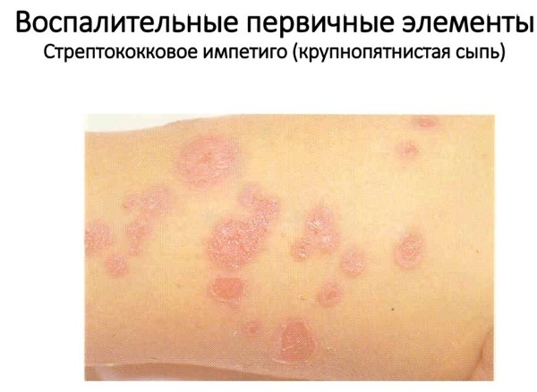 Красные пятна на теле у взрослого - появились красные пятнышки на лице