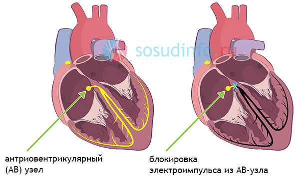 Что такое ав блокада сердца