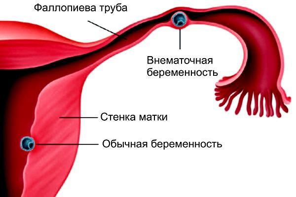 Кровь из влагалища, почему идет кровь из влагалища, после секса, но не месячные, при беременности