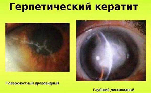 Ацикловир глазная мазь: инструкция по применению, цена