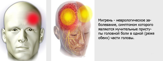 Мигрень: причины, симптомы и лечение болезни