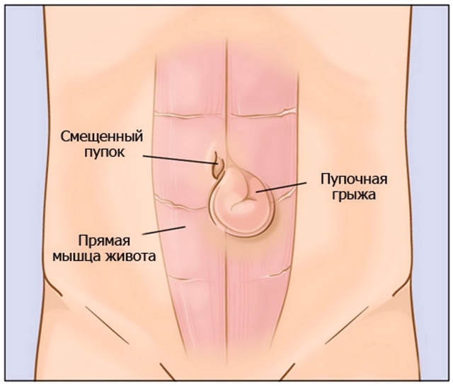 Пупочная грыжа у женщин, у взрослых – симптомы, лечение без операции, операция