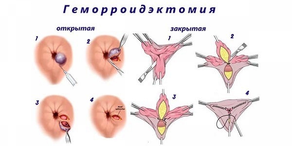 Что такое геморроидэктомия, послеоперационный период