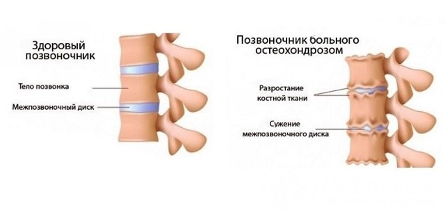 Остеохондроз грудной клетки