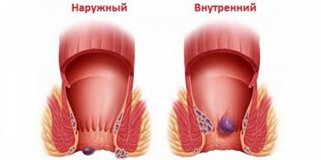 Профилактика геморроя у мужчин в домашних условиях: диета и упражнения