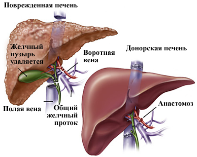 Пересадка печени: виды, выбор донора, ход процедуры.