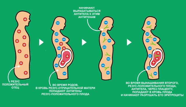 Несовместимость по группе крови партнеров при беременности