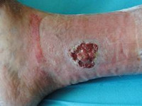 Трофические язвы нижних конечностей: виды, симптомы, лечение