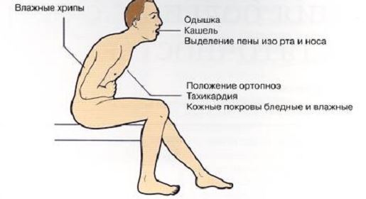Кашель при сердечной недостаточности - Гипертонии нет