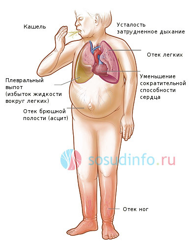 Кардиогенный отек легких - причины, симптомы, диагностика и лечение