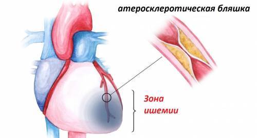 Ишемическая болезнь сердца: симптомы и лечение ишемической болезни сердца, что это такое и чем оно опасно для человека