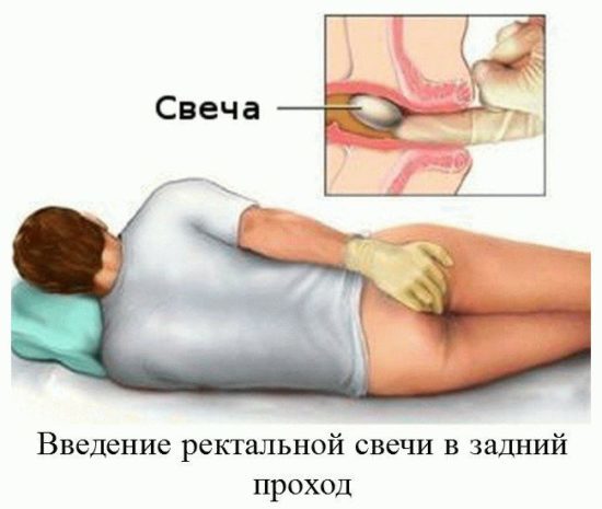Свечи из картофеля от геморроя: как делать, лечение