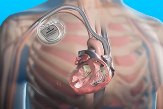 Дисметаболическая кардиомиопатия: симптомы и лечение