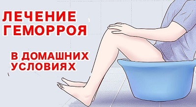 Геморрой - лечение, симптомы, как лечить в домашних условиях