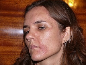 Чем лечить аллергический дерматит у взрослых и детей? Симптомы и фото