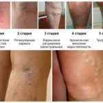 Внутренний варикоз на ногах (скрытый): симптомы и лечение