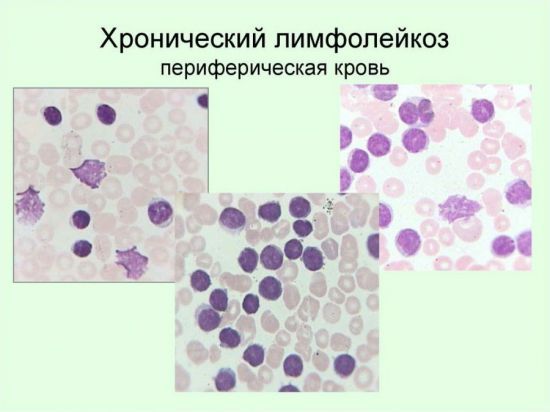 Лимфоциты в крови повышены: причины у женщин цимфацитоза