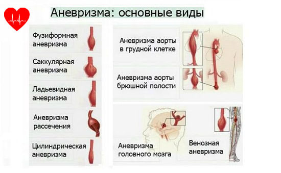 Аневризма сердца - Боль в Сердце