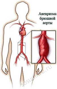 Кальциевые бляшки в сердце - Все про гипертонию