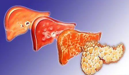 Анализ крови на HCV и HBS: что это означает?