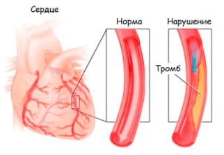 Скорая помощь при аритмии