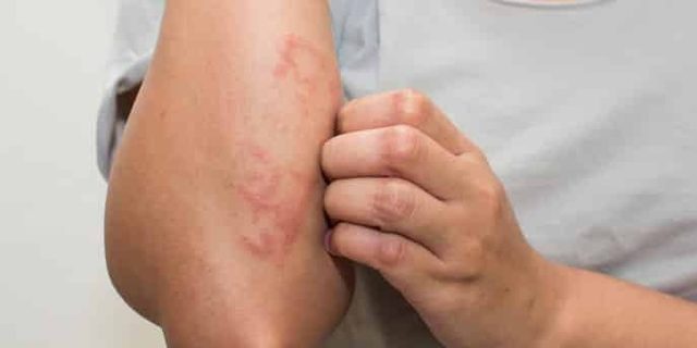 Сдать кровь на аллергены