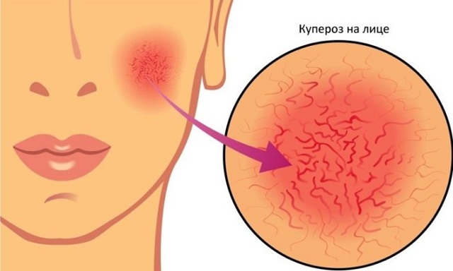 Сосудистая звездочка на лице у ребенка - симптомы и причины появления