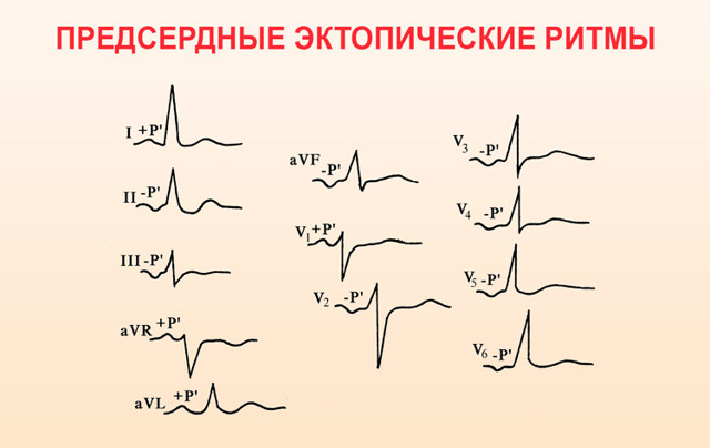 Среднеправопредсердный эктопический ритм: в домашних условиях, меню, обострение, отзывы